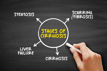 Stages of cirrhosis (scarring of the liver caused by long-term liver damage) mind map text concept...