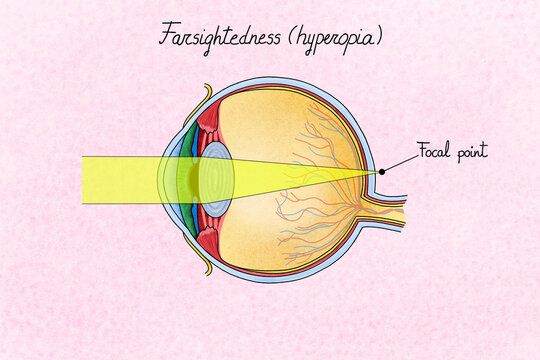 Human eye with farsightedness (hyperopia). Illustration