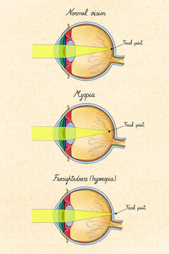 Human eye with different disordes. Illustration