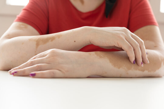 Portrait Of An Anonymous Girl With Vitiligo Skin