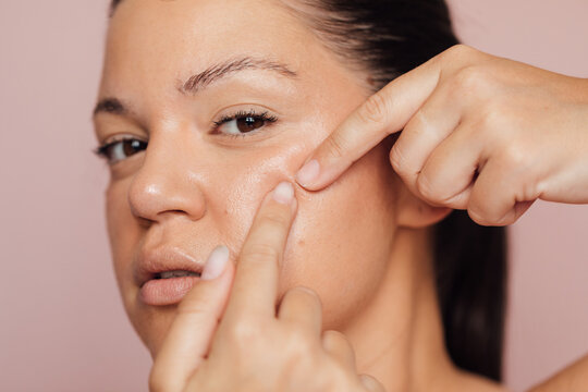 Woman Popping Pimple