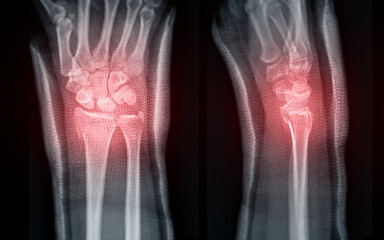 The X-ray image vividly displays a wrist joint fracture, offering a clear visual representation for...