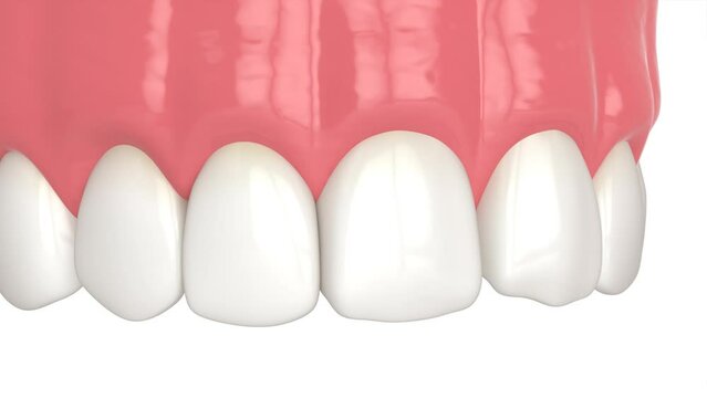 Crooked tooth treatment using bonding procedure with composite resin 