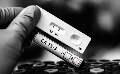Blood sample of patient positive tested for CA 153 by rapid diagnostic test.