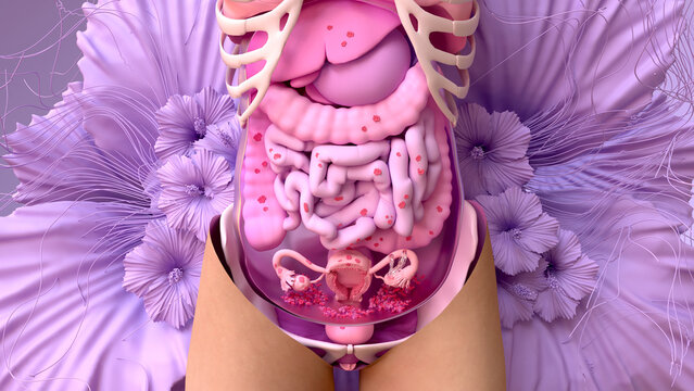 Endometriosis, disease of the female reproduction system