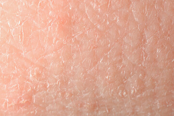 Texture of dry skin as background, macro view - obrazy, fototapety, plakaty
