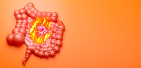 Human guts are on fire. Digestive problems. Heartburn in person intestines. Disease of gastrointestinal tract. Symptoms of heartburn in patient. Intestinal tract is at gunpoint on orange. 3d image - obrazy, fototapety, plakaty