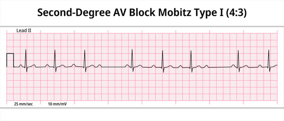 ECG Second Degree AV Block Mobitz Type 1 (4:3) - 8 Second Paper Electrocardiogram - Medical Vector Illustration