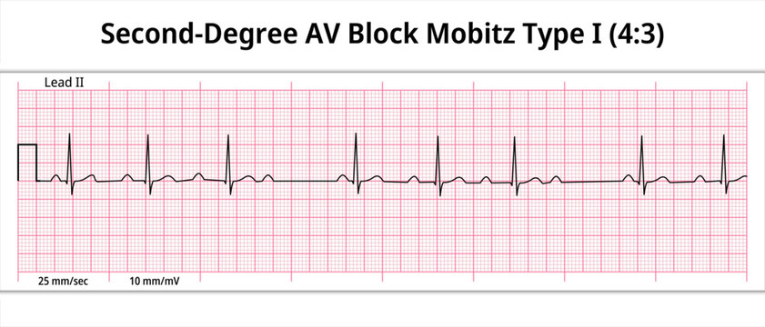 ECG Second Degree AV Block Mobitz Type 1 (4:3) - 8 Second Paper Electrocardiogram - Medical Vector Illustration