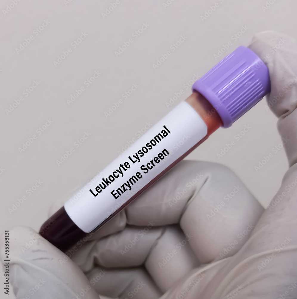 Poster blood sample for leukocyte lysosomal enzyme screen to diagnosis of fucosidosis, wolman disease.