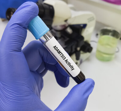 Blood sample for ADAMTS13 Activity or von Willebrand Factor Cleaving Protease test to diagnosis of thrombotic thrombocytopenic purpura (TTP).
