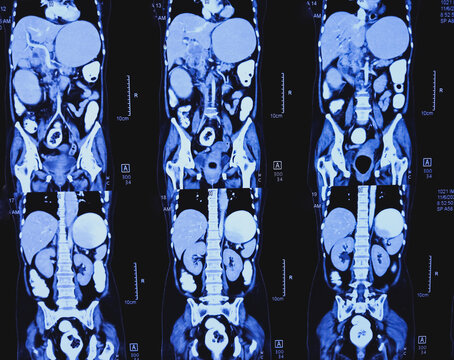 CT (Computed Tomography) scan of Whole abdomen. Soft tissue mass in epigastric region, lymphadenopathy, GIST, hugely distended stomach containing food residue.