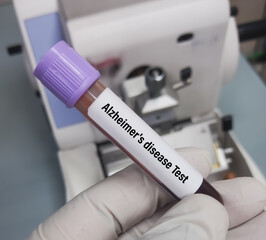 Blood sample for ATN (Amyloid-Tau-Neurodegeneration) profile test, to diagnosis of Alzheimer's disease. Alzheimer's test.