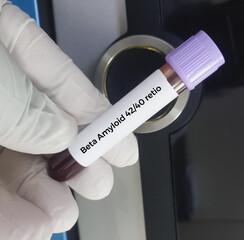 Blood sample for Beta Amyloid 4240 Ratio, Plasma test, to diagnosis of Alzheimer's disease....