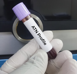Blood sample for ATN (Amyloid-Tau-Neurodegeneration) profile test, to diagnosis of Alzheimer's...