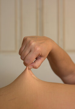 Hand of woman with Ehlers-Danlos syndrome stretching skin of stomach area