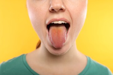 Gastrointestinal diseases. Woman showing her yellow tongue on color background, closeup