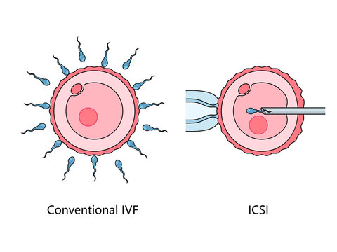 contrasting conventional In Vitro Fertilization (IVF) with Intracytoplasmic Sperm Injection (ICSI) technique hand drawn schematic raster illustration. Medical science educational illustration