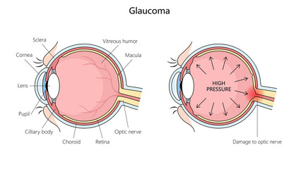 anatomy of a human eye with glaucoma, highlighting increased pressure and optic nerve damage structure diagram hand drawn schematic raster illustration. Medical science educational illustration - obrazy, fototapety, plakaty
