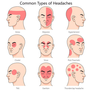Human headache type structure diagram hand drawn schematic raster illustration. Medical science educational illustration