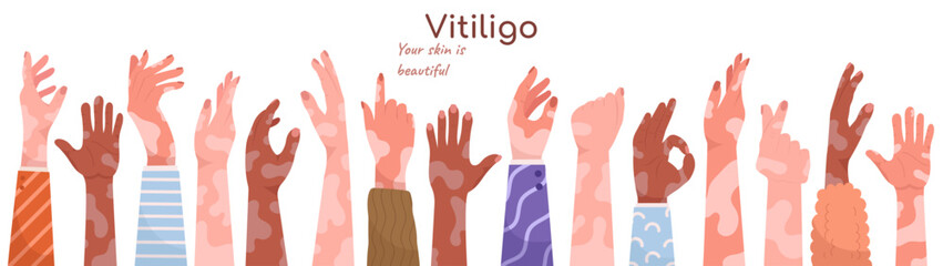 Various human hands with vitiligo depigmentation dermatology disease set vector illustration