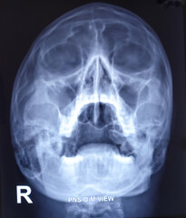 PNS Xray OM view film, bilateral maxillary and frontal sinusitis with hypertrophied inferior...