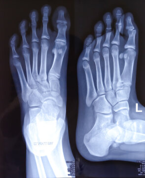 X-ray or radiograph of an ankle showing anatomy of bones and joint of ankle and foot in a patient with ankle sprain.