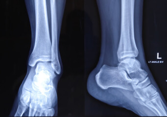 X-ray or radiograph of an ankle showing anatomy of bones and joint of ankle and foot in a patient with ankle sprain.