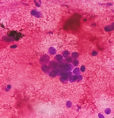 CT Guaided FNA cytology from left hilar mass. Microscopic show atypical small cells, malignant...