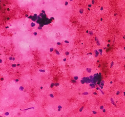 CT Guaided FNA cytology from left hilar mass. Microscopic show atypical small cells, malignant...