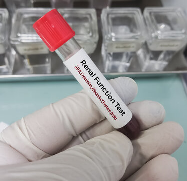 Blood sample for Renal Function test (Creatinine, BUN, eGFR, albumin, total protein, creatinine clearance) for diagnosis of renal or kidney disease.