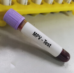 Blood sample for Mean Platelet Volume (MPV) test, MPV blood test, to measures the average size of...