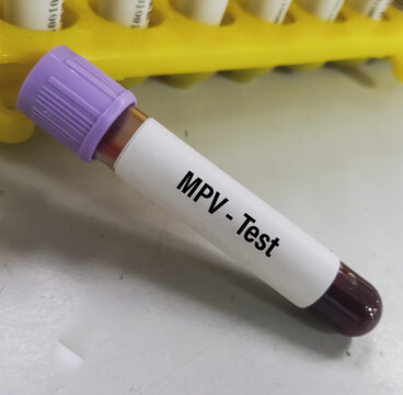 Blood sample for Mean Platelet Volume (MPV) test, MPV blood test, to measures the average size of your platelets. help diagnose bleeding disorders and diseases of the bone marrow.