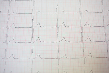 Electrocardiogram in pink paper form in hospital, close up view