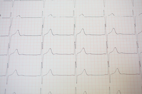 Electrocardiogram in pink paper form in hospital, close up view