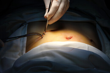 Doctor is pressing puncture with clinches at the center of endosurgery and lithotripsy