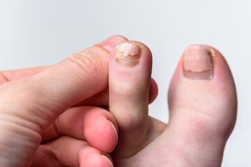 Damaged toenails with acrylic polish on gray background.