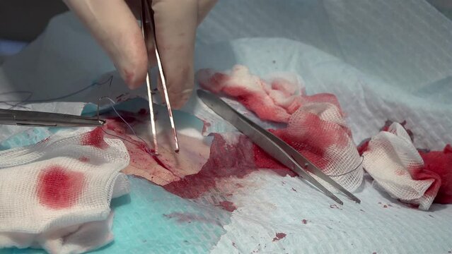 Doctor suturing wound with needle and self dissolving thread during a surgery.