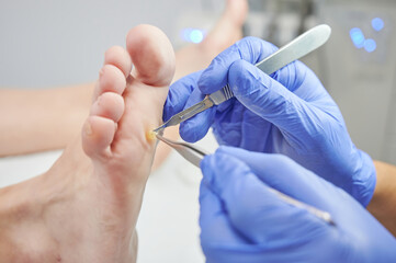 Podiatrist removing a foot callous in his podiatry clinic using tweezers and scalpel to grab and...