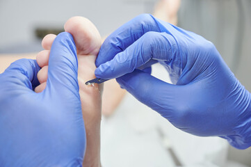 podiatrist hands with blue gloves operating on callous hyperkeratosis in his podiatry clinic. Holds...