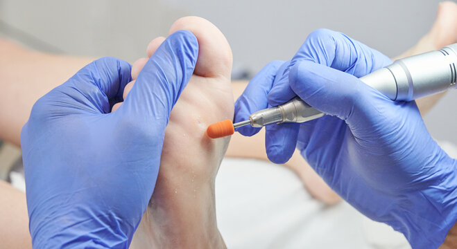Podiatrist using a medical drill to remove a callosity (hyperkeratosis) from the sole of the foot. Scenes from a podiatry clinic