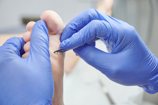 podiatrist hands with blue gloves operating on callous hyperkeratosis in his podiatry clinic. Holds a patient's foot while using the scalpel to eliminate discomfort when walking.