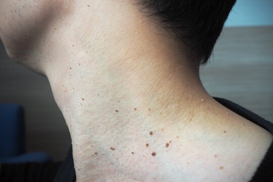 Many skin tags or Acrochordon on the neck They are small soft and common benign on the human skin especially on adult skin and can be irritated by shaving and daily clothing