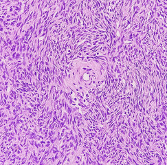 Photo of benign brenner tumor of ovary, showing tumor sheet on the right side and ovarian stroma on...