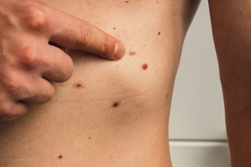 Male hand showing birthmarks on skin body stomach part. Close up detail of the bare skin. Health Effects of UV Radiation. Man with birthmarks Pigmentation