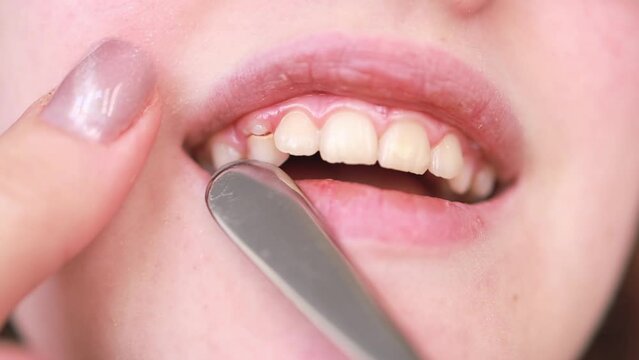 Growth of molars in an adolescent.