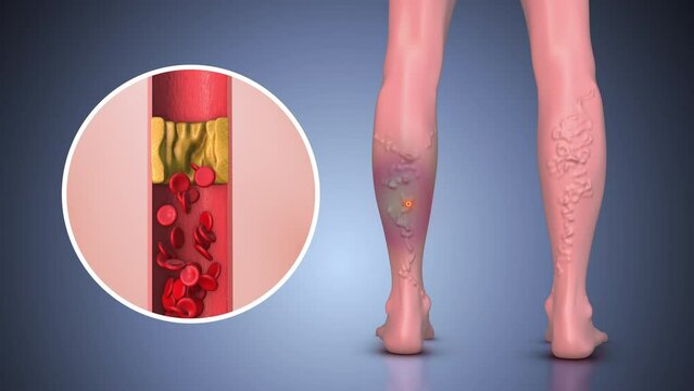 Concept of peripheral pain in human leg with vericose vein	