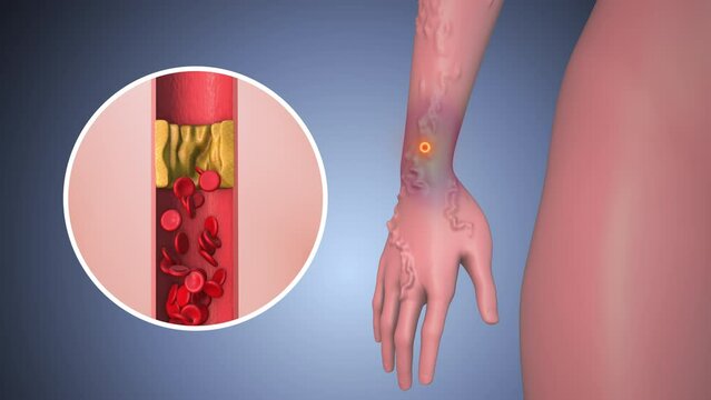 Peripheral pain in human hand with vericose vein

