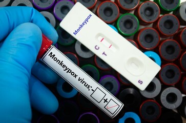 Fototapeta premium Blood sample of patient positive tested for monkeypox virus by rapid diagnostic test.