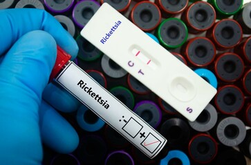 Fototapeta premium Blood sample of patient positive tested for rickettsia by rapid diagnostic test.